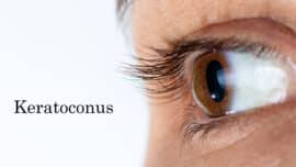 Keratoconus - eye disease, thinning cornea