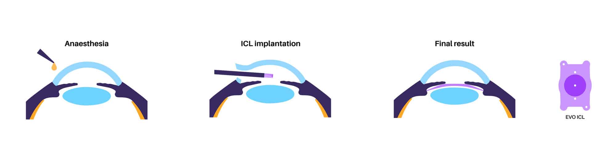 EVO ICL illustration