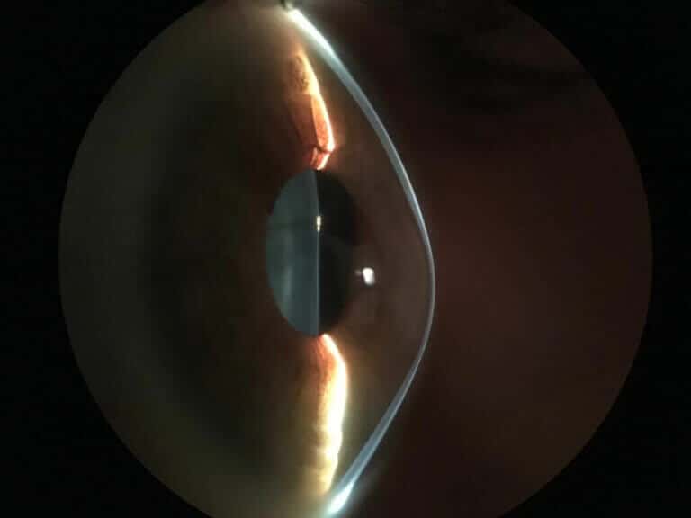 Understanding Keratoconus Causes Symptoms And Diagnosis